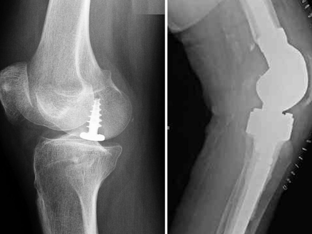 roentgen_knie Radfahren nach Verletzungen
